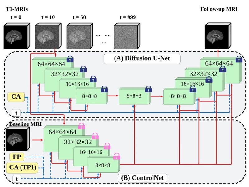 Predictive AI model could help forecast neurodegenerative diseases